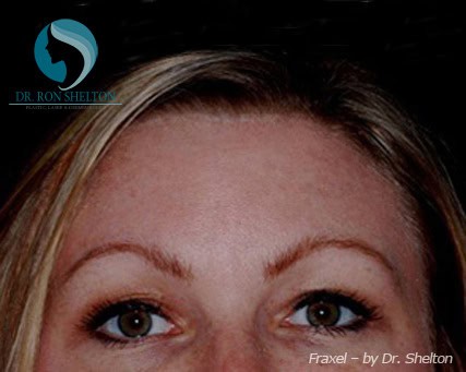 fraxel-a-1 After Fraxel treatment for Melasma