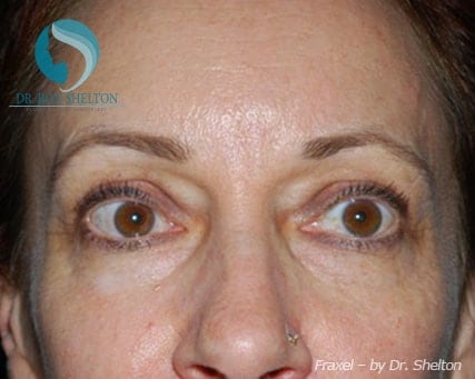fraxel-a-2 After Fraxel for Melasma