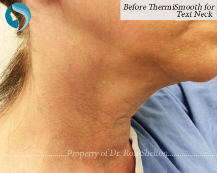textneck-thermismooth-b2 Thermismooth for text neck - before image