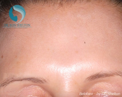 After Botox in Mid Forehead