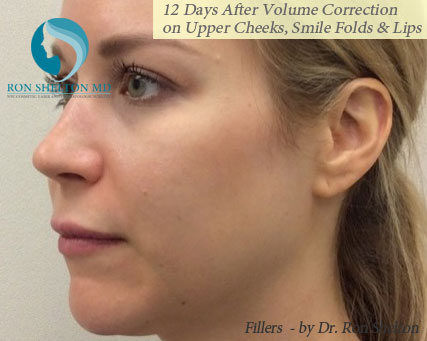 12 Days After Voluma to Upper cheeks, Vollure to smile folds and marionette lines and Volbella to lips