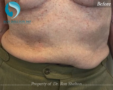 Before Coolsculpting