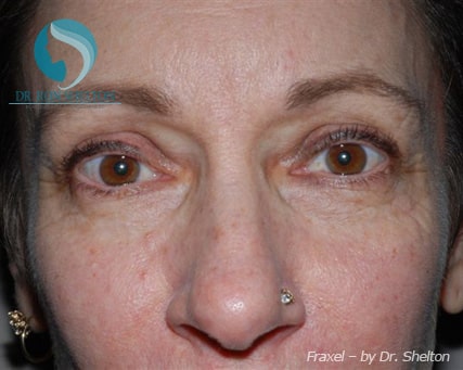 fraxel-b-2 Before Fraxel for Melasma
