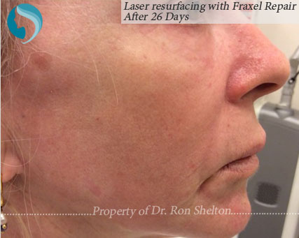26 Days after Laser resurfacing with Fraxel Repair, CO2