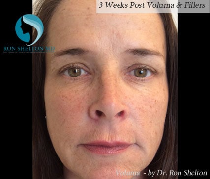 3 Weeks Post Voluma & Fillers