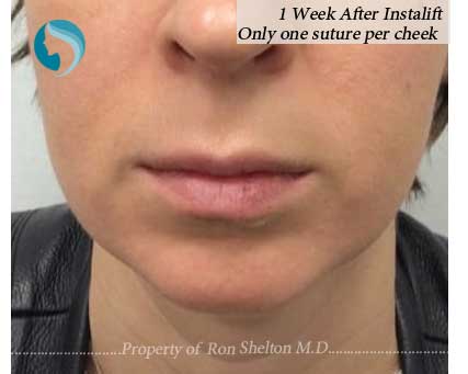 One Week after Instalift Only one suture per cheek