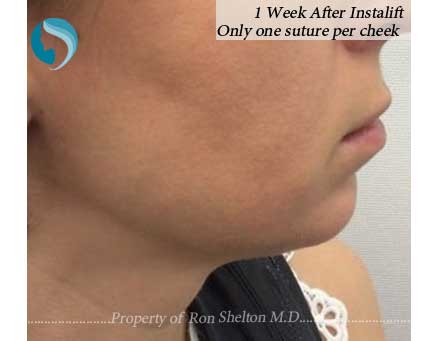 aft-instalift-3 One Week after Instalift, Only one suture per cheek