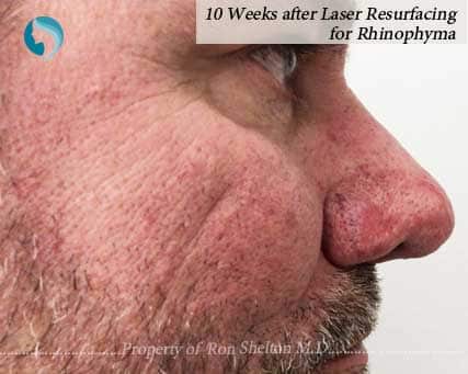10 Weeks after Laser Resurfacing of Rhinophyma