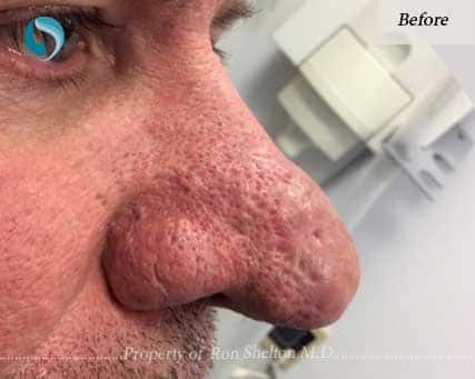 Before Laser Resurfacing