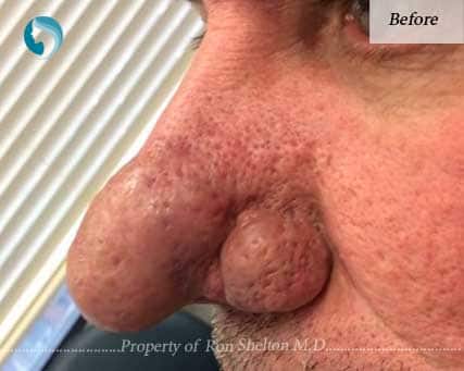 Before Laser Resurfacing