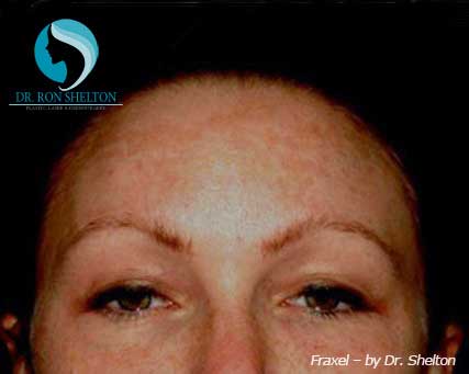 melasma Before Fraxel treatment for Melasma