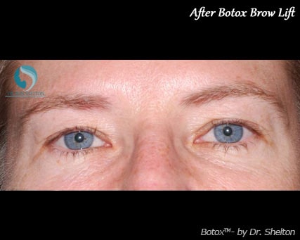After Botox Brow Lift NYC