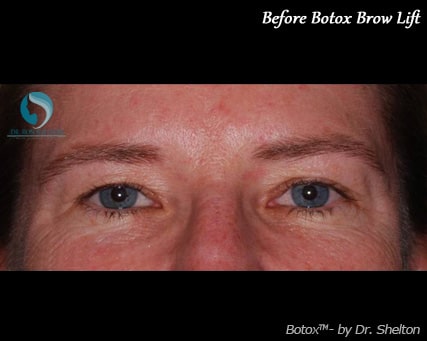 Before Botox Brow Lift NYC