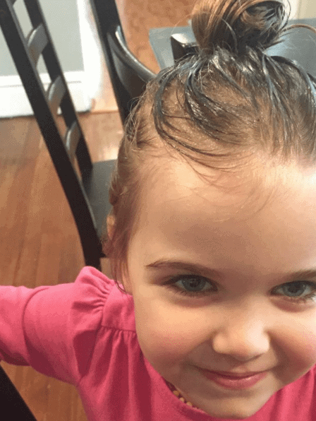 selsun blue cradle cap face