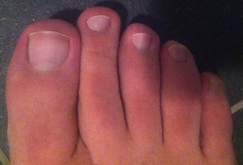 If your second toe is longer than your big toe, you have Morton's toe