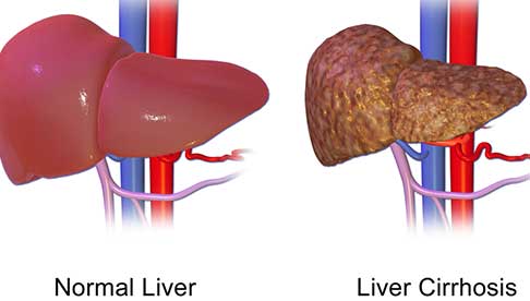 coffee-health-benefits-reduces-risk-of-liver-cirrhosis