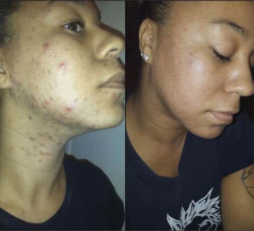 peeling peeling