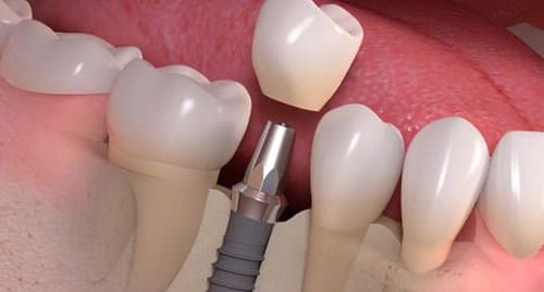 Single Dental Implant