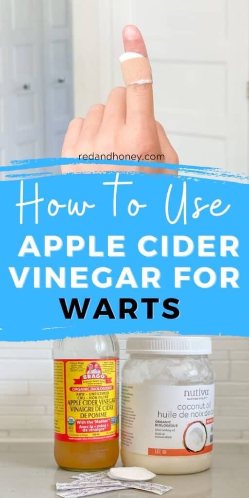 How to Use Apple Cider Vinegar for Warts (Effective Home Remedy)
