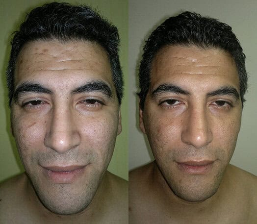 peeling peeling