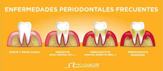 La periodoncia trata enfermedades de las encías que son la base de una dentadura sana como los cimientos de una casa que es lo que se muestra en la imagen