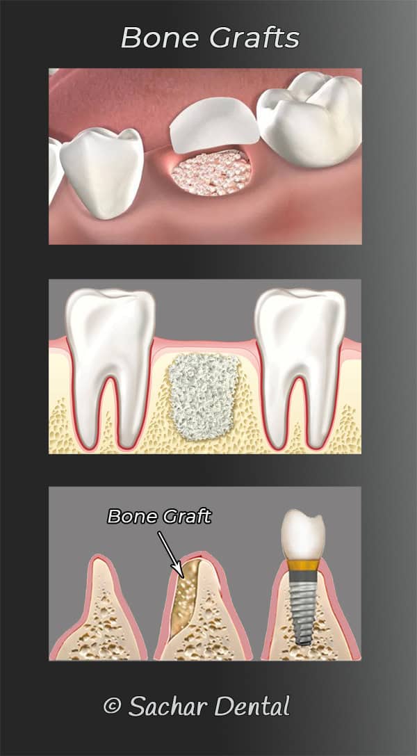 Dentist NYC bone graft, dental implants Picture of diagrams of bone grafting for Dental implants