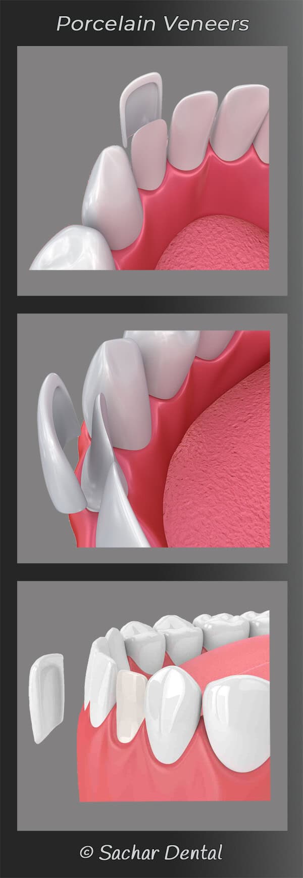 Top Cosmetic Dentist NYC for porcelain caps Cosmetic Dentist NYC porcelain veneers diagram