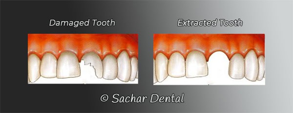 Dentist Nyc Tooth Extraction Nyc Sachar Dental Nyc