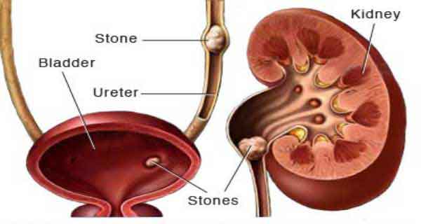 kidney-stones-high-uric-acid