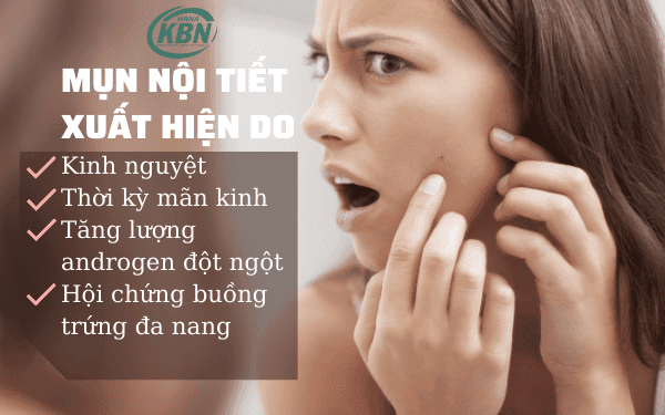 Nguyên nhân chính dẫn đế mụn nội tiết