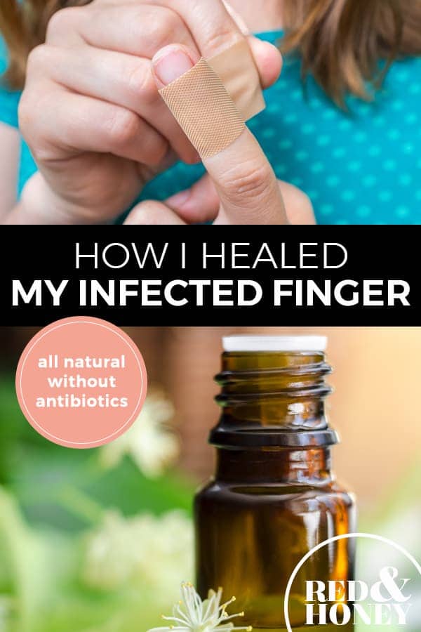 How I Healed My Infected Finger without Antibiotics Red and Honey
