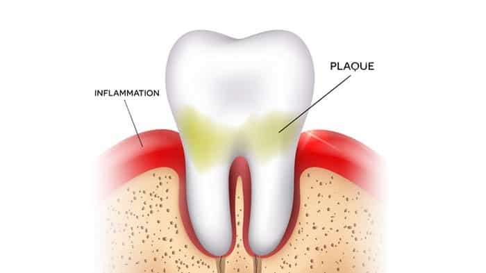 Stage One Gum Disease