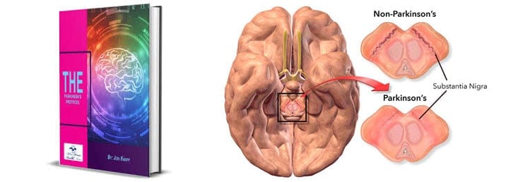 The Parkinson's Protocol Review