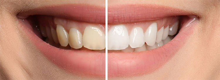 Improve Teeth