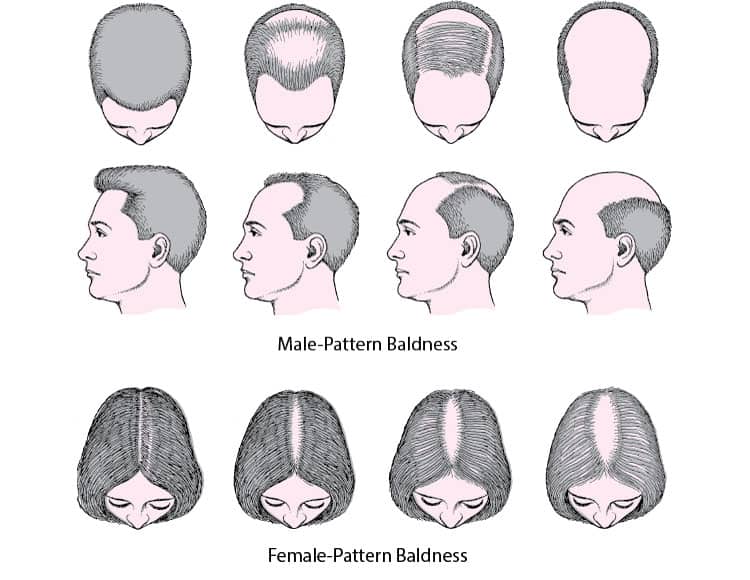 Male-Women-Baldness
