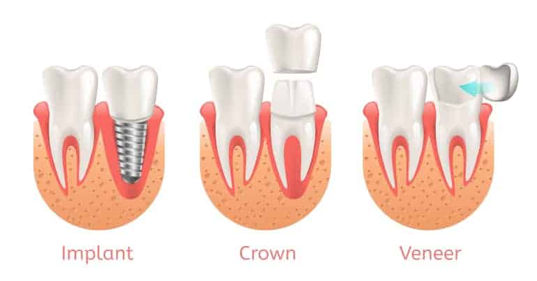 Dental Implants Crowns Veneers