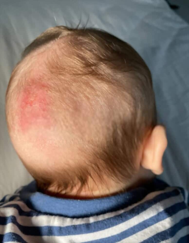 3 reasons for your toddler's dry scalp & Best Treatment Options! toddlers dry scalp