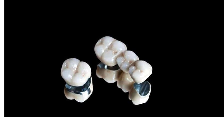 ครอบฟันโลหะผสมกับพอร์ซเลน (Porcelain Fuse to Metal Crown : PFM )