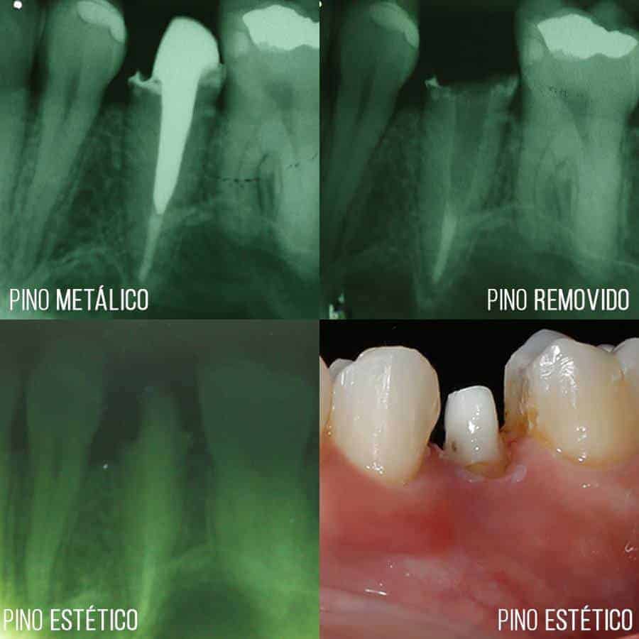 Para que serve um Pino Dentário? 2 pino estetico em fibra de vidro