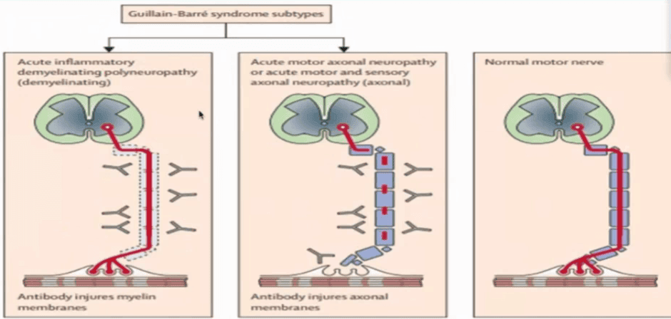 Catatan Koas2doctor Guillain Barre Syndrome Update Koas2doctor