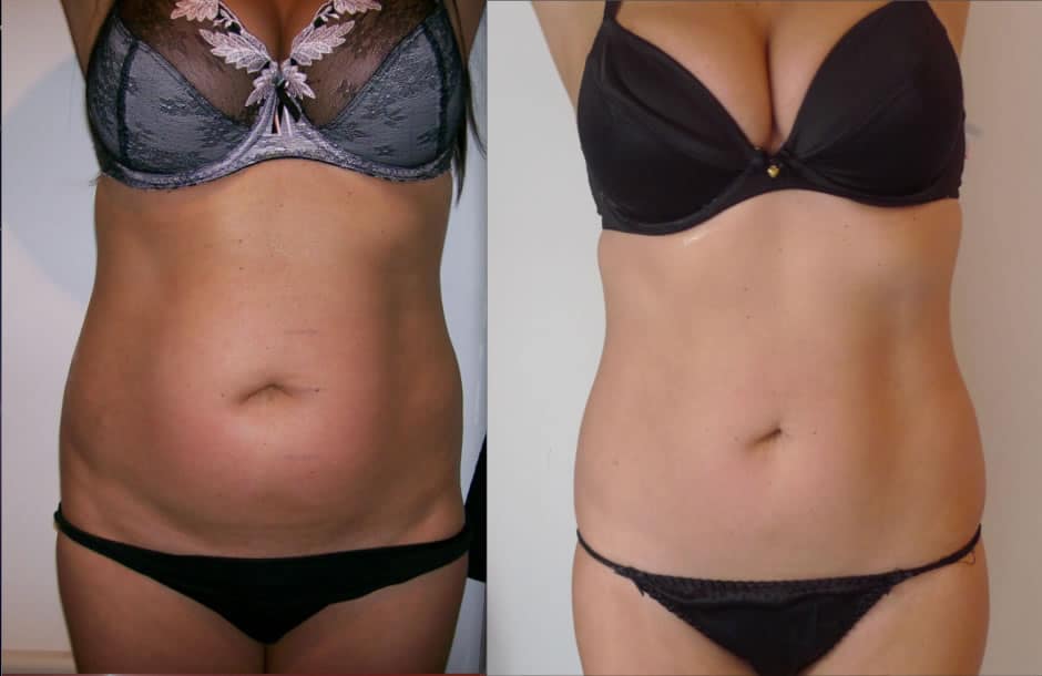 antes y después de la carboxiterapia