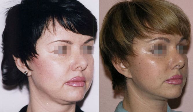 Подтяжка лица (фейслифтинг) 23