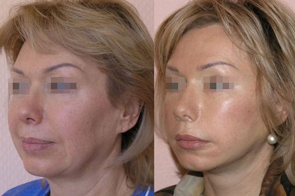 Подтяжка лица (фейслифтинг) 9