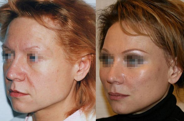Подтяжка лица (фейслифтинг) 8