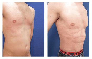 LIPOSUCTION ALTERNATIVES