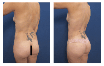 360 liposuction Laguna Beach