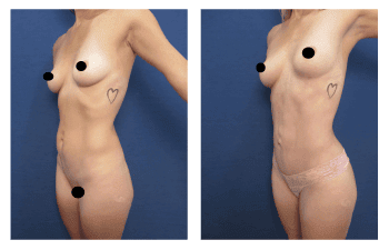 High definition liposuction Beverly Hills