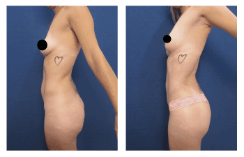 Liposuction meaning