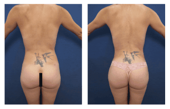 VASER HD Lipo San Diego