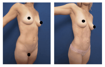 High definition liposuction Newport Beach